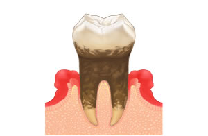 中等度の歯周病治療費
