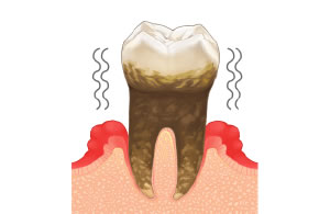 重度の歯周病治療費