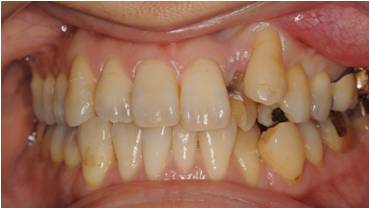 乱ぐい歯の矯正治療前