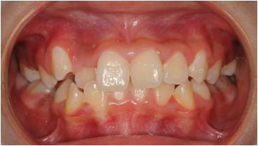 乱ぐい歯の小児矯正治療前