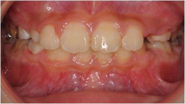 拡大床の小児矯正治療後