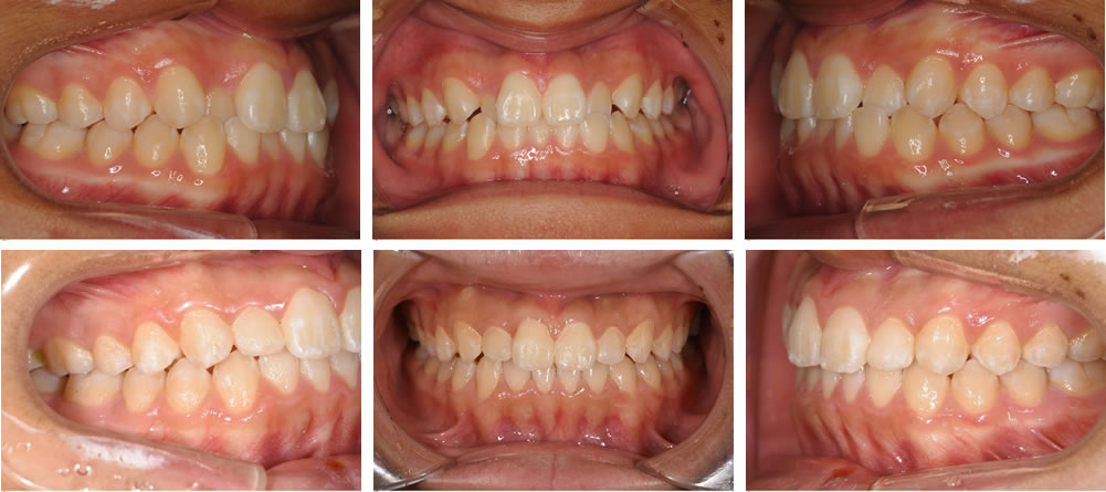 八重歯・叢生の治療例